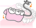 部分入れ歯